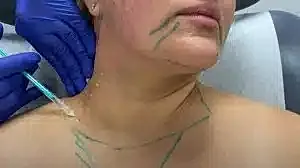 Injection procedure with markings on the neck.