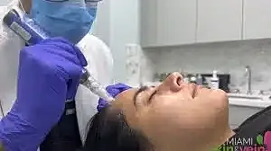 Microneedling treatment in a clinical setting.