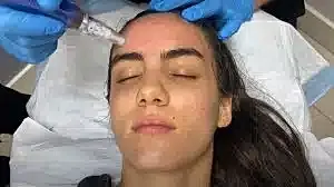 Person receiving microneedling treatment on forehead.