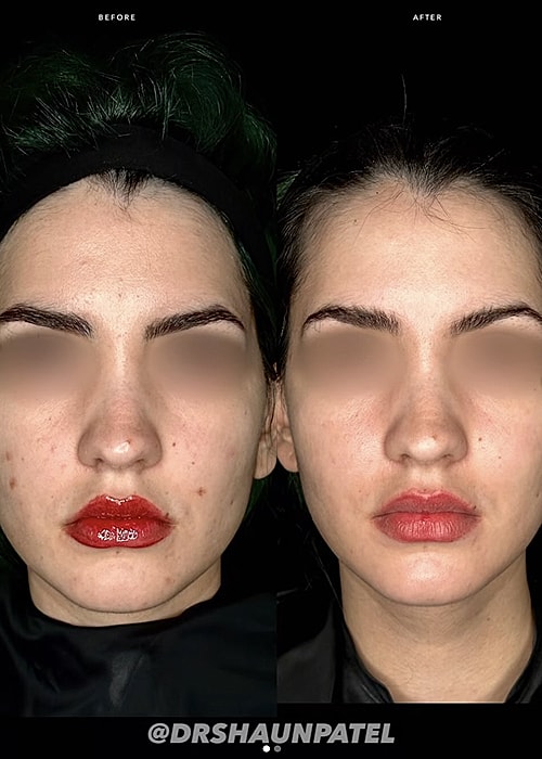 Before and after beauty treatment comparison.