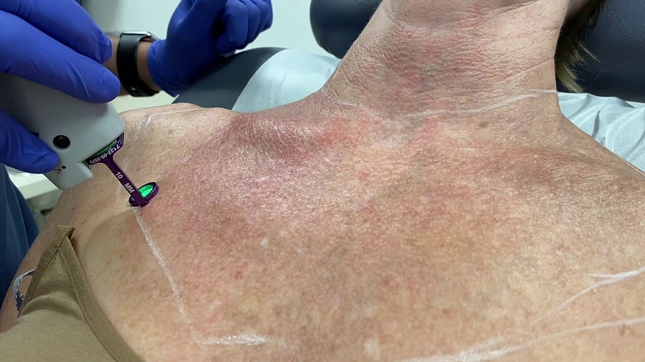 Laser treatment on a patient's chest area.