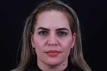 Dermal Fillers Before & After