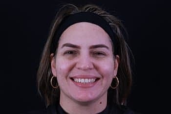 Dermal Fillers Before & After