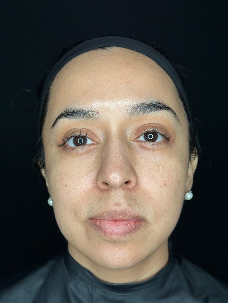 Dermal Fillers Before & After