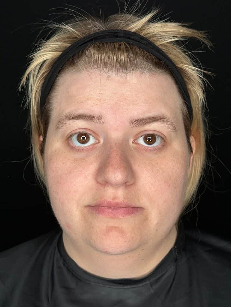 Dermal Fillers Before & After