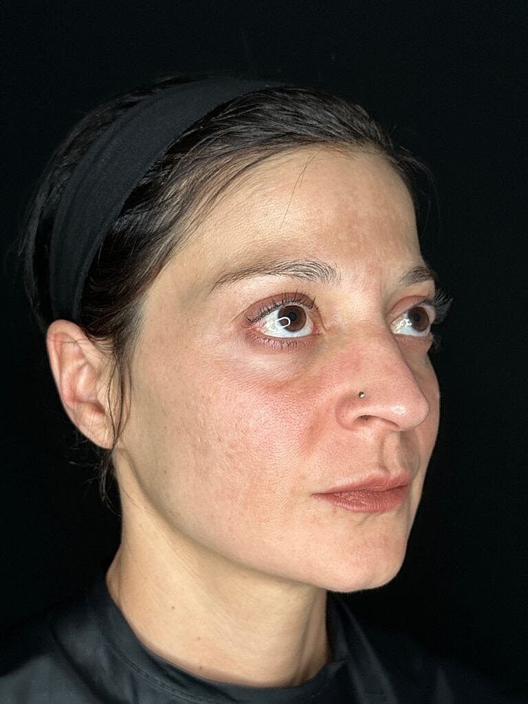 Dermal Fillers Before & After