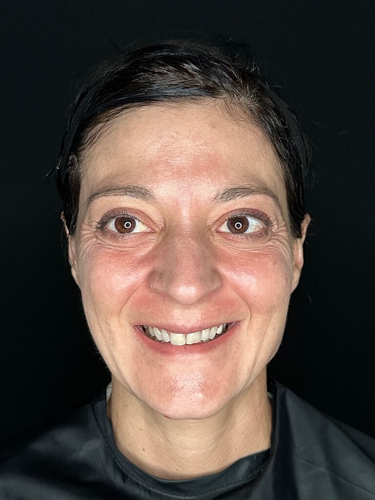 Dermal Fillers Before & After