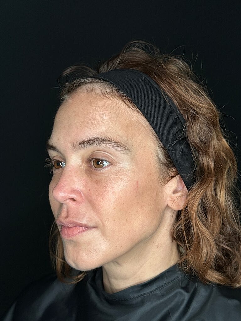 Dermal Fillers Before & After