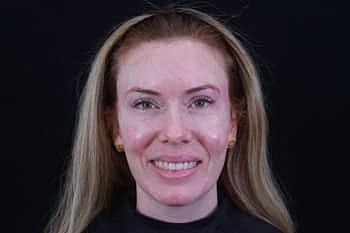 Dermal Fillers Before & After