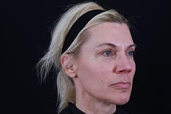 Dermal Fillers Before & After