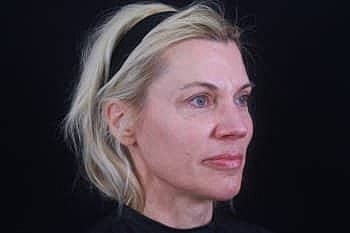 Dermal Fillers Before & After