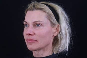 Dermal Fillers Before & After