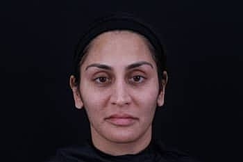 Dermal Fillers Before & After