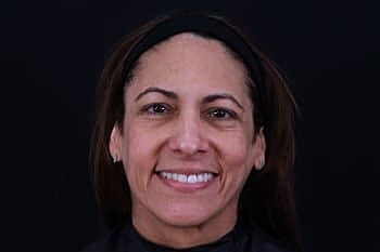 Dermal Fillers Before & After