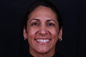 Dermal Fillers Before & After