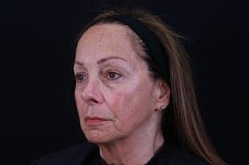 Dermal Fillers Before & After