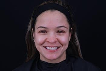 Dermal Fillers Before & After