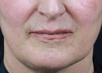 Dermal Fillers Before & After