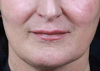 Dermal Fillers Before & After