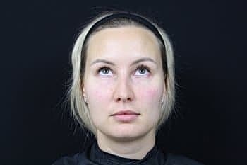 Dermal Fillers Before & After