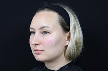 Dermal Fillers Before & After