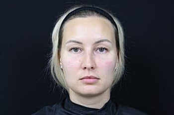 Dermal Fillers Before & After