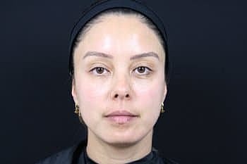 Dermal Fillers Before & After