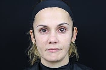 Dermal Fillers Before & After