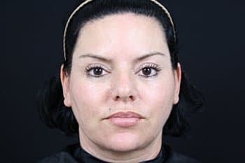 Dermal Fillers Before & After