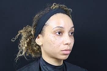 Dermal Fillers Before & After