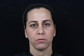 Dermal Fillers Before & After