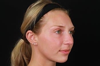 Dermal Fillers Before & After