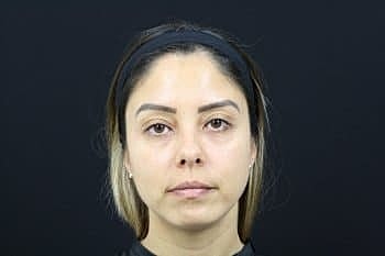 Dermal Fillers Before & After