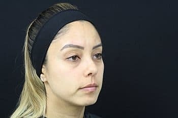 Dermal Fillers Before & After