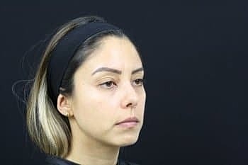 Dermal Fillers Before & After