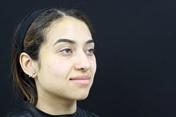 Dermal Fillers Before & After