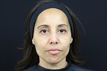 Dermal Fillers Before & After