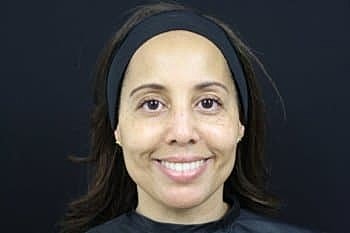 Dermal Fillers Before & After