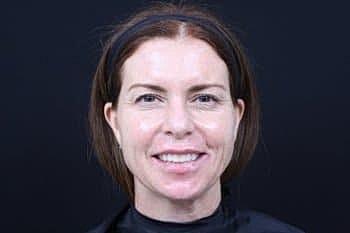 Dermal Fillers Before & After