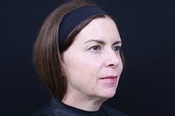 Dermal Fillers Before & After