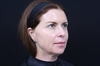 Dermal Fillers Before & After