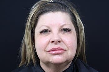 Dermal Fillers Before & After