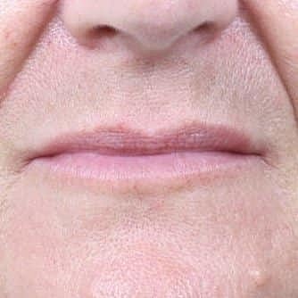 Dermal Fillers Before & After