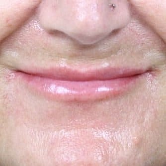 Dermal Fillers Before & After