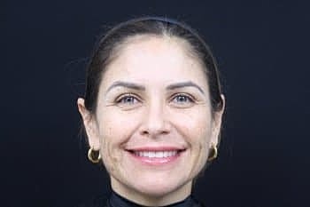 Dermal Fillers Before & After