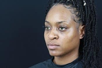 Dermal Fillers Before & After