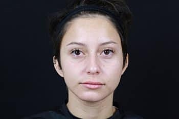 Dermal Fillers Before & After