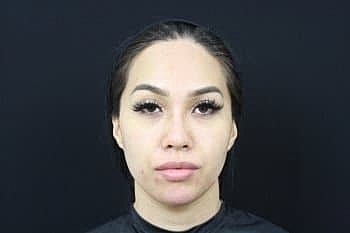 Dermal Fillers Before & After