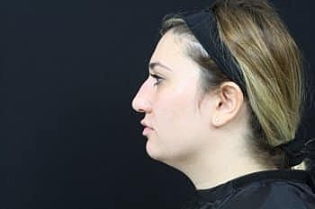 Dermal Fillers Before & After