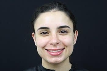 Dermal Fillers Before & After